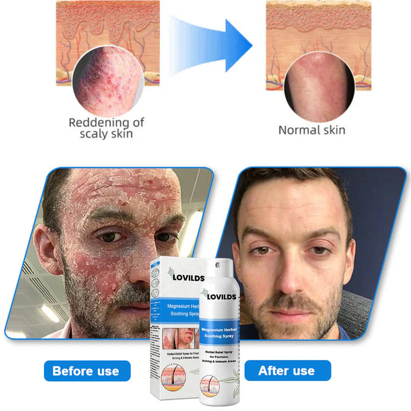 ✅ Official Store: LOVILDS® Magnesium Herbal Psoriasis Spray ⚕️ FDA Certified (Relieves psoriasis and eczema, improves bacterial infections in the genital area, treats acne and warts, relieves joint pain and neuropathic pain)