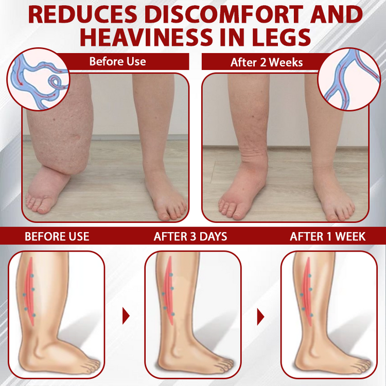LOVILDS® (Official retail store） Red Vine Fluid Relief Edema Gel