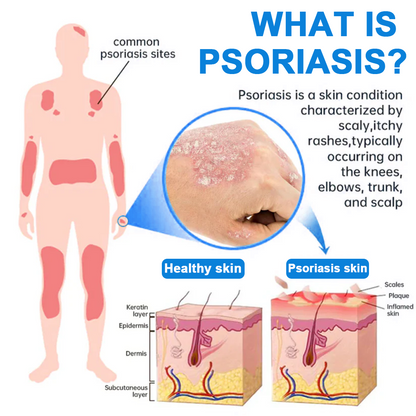 ✅ Official Store: LOVILDS® Magnesium Herbal Psoriasis Spray ⚕️ FDA Certified (Relieves psoriasis and eczema, improves bacterial infections in the genital area, treats acne and warts, relieves joint pain and neuropathic pain)