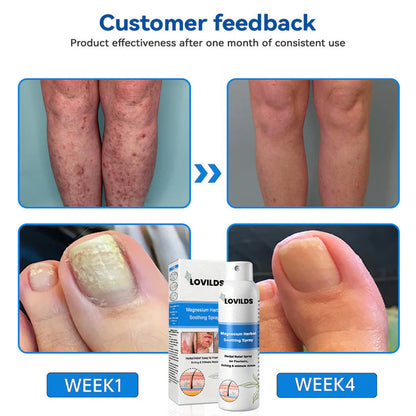 ✅ Official Store: LOVILDS® Magnesium Herbal Psoriasis Spray ⚕️ FDA Certified (Relieves psoriasis and eczema, improves bacterial infections in the genital area, treats acne and warts, relieves joint pain and neuropathic pain)
